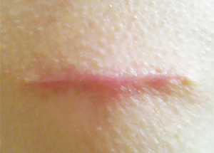 縫った痕はきれいになったが傷口は薄いピンクのケロイドになっている。